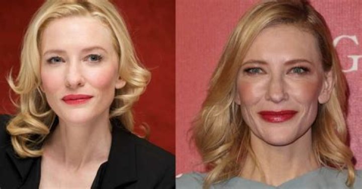 Cate Blanchett Plastic Surgery And Teeth Veneers – Fake Tooth Photos
