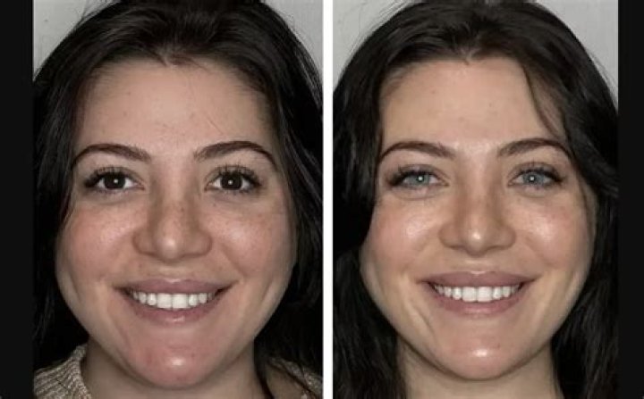 Does Eva Birthistle Have A Glass Eye? Fake News On Eyes Surgery Surface On Internet