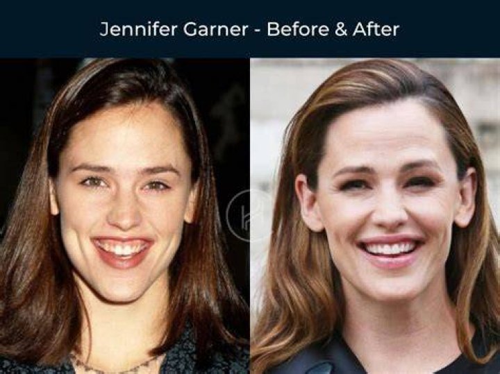 What’s Wrong With Gabi Butler Teeth? Before And After Fixing – Cheer