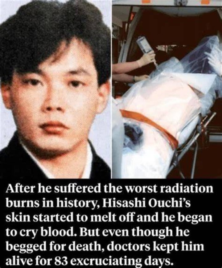 Who Was Hisashi Ouchi? Radiation Burn Body Images On Reddit, Before And After!